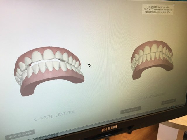 invisalign- first six weeks